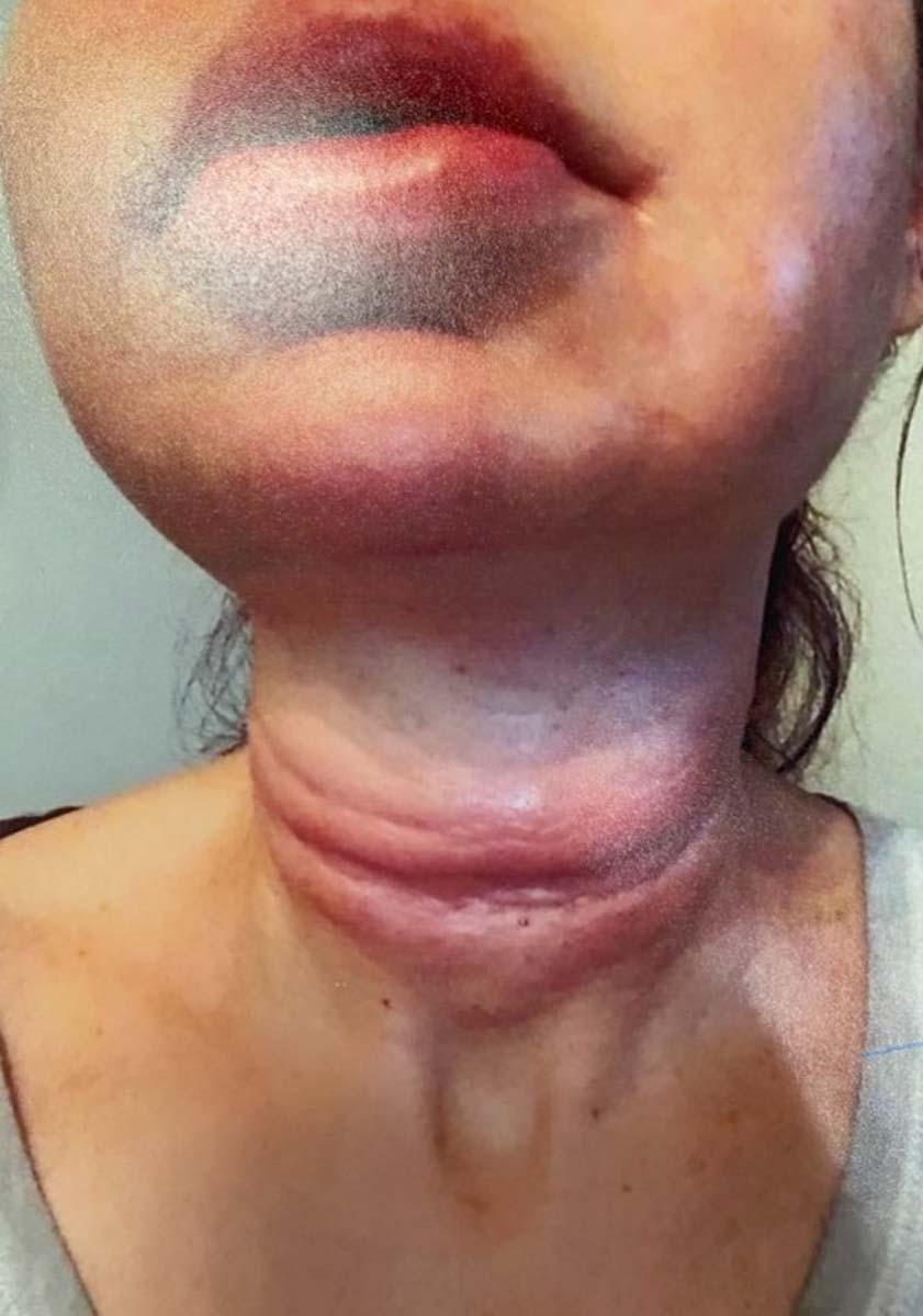 Estetisyen diplomasız çıktı! Dolgu yaptırmak isteyen kadın, sahte doktor yüzünden bambaşka biri oldu!