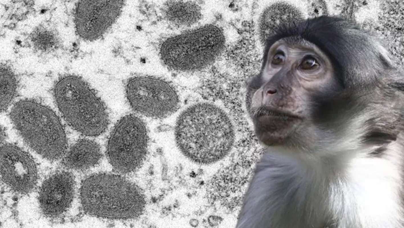 DSÖ alarma geçmişti! Maymun çiçeği virüsü en çok eşcinsellere mi bulaşıyor? 