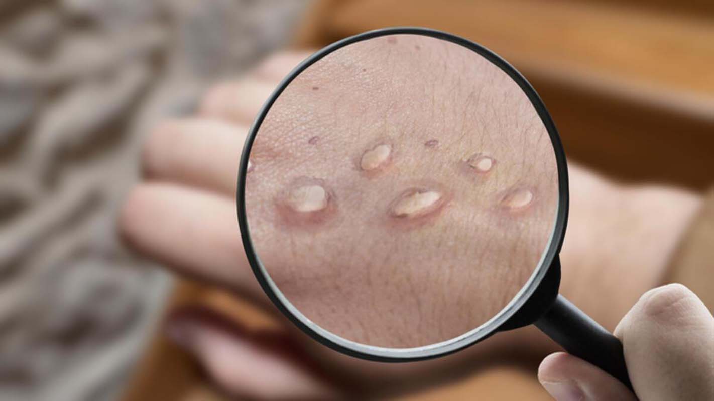 DSÖ alarma geçmişti! Maymun çiçeği virüsü en çok eşcinsellere mi bulaşıyor? 