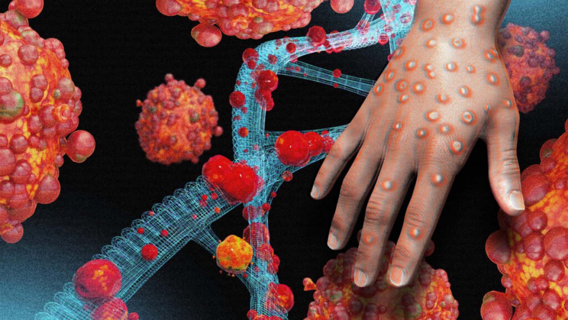 Koronavirüs bitmeden ortaya çıkmıştı! Maymun çiçeğinde son durum belli oldu! İşte vakalardaki kritik detay