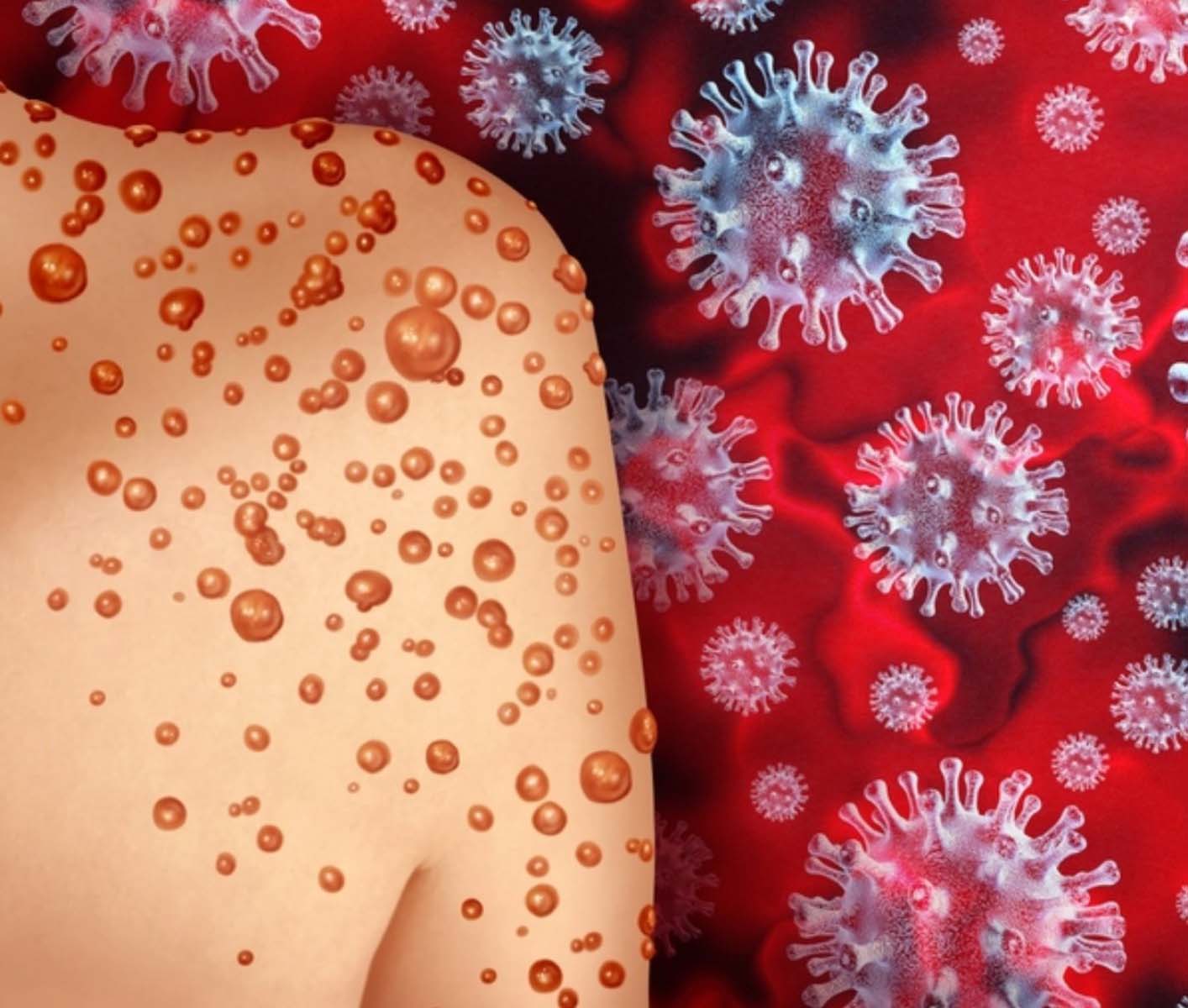 Koronavirüs bitmeden ortaya çıkmıştı! Maymun çiçeğinde son durum belli oldu! İşte vakalardaki kritik detay