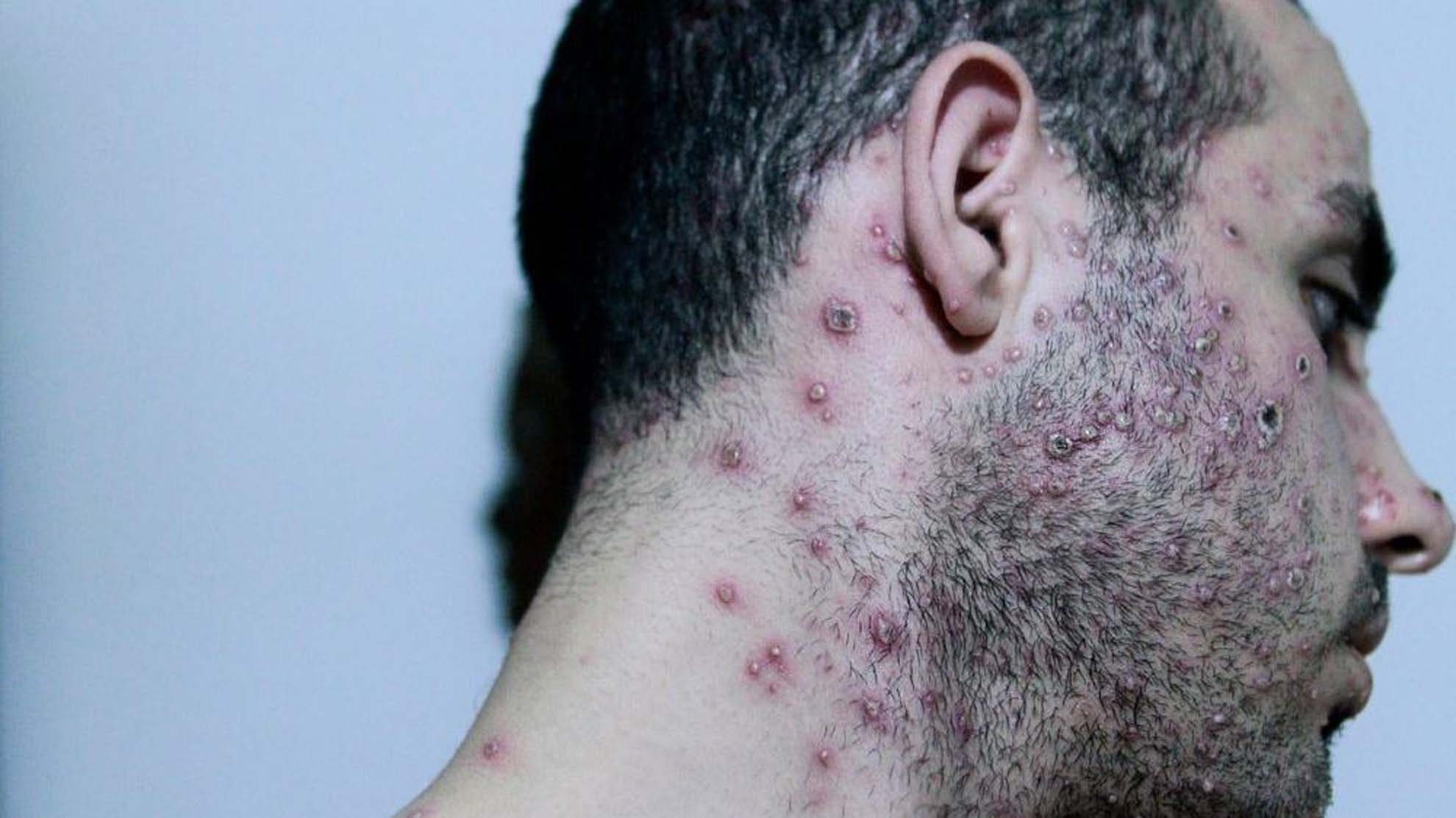 Koronavirüs bitmeden ortaya çıkmıştı! Maymun çiçeğinde son durum belli oldu! İşte vakalardaki kritik detay