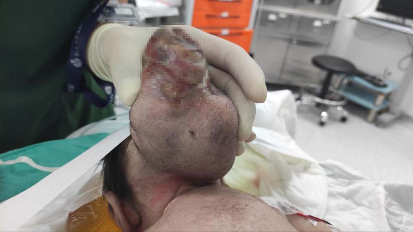 Kahramanmaraş'taki bebeği gören inanamadı! Beynin yarısı kafatasının dışındaydı! Daha 11 günlükken...