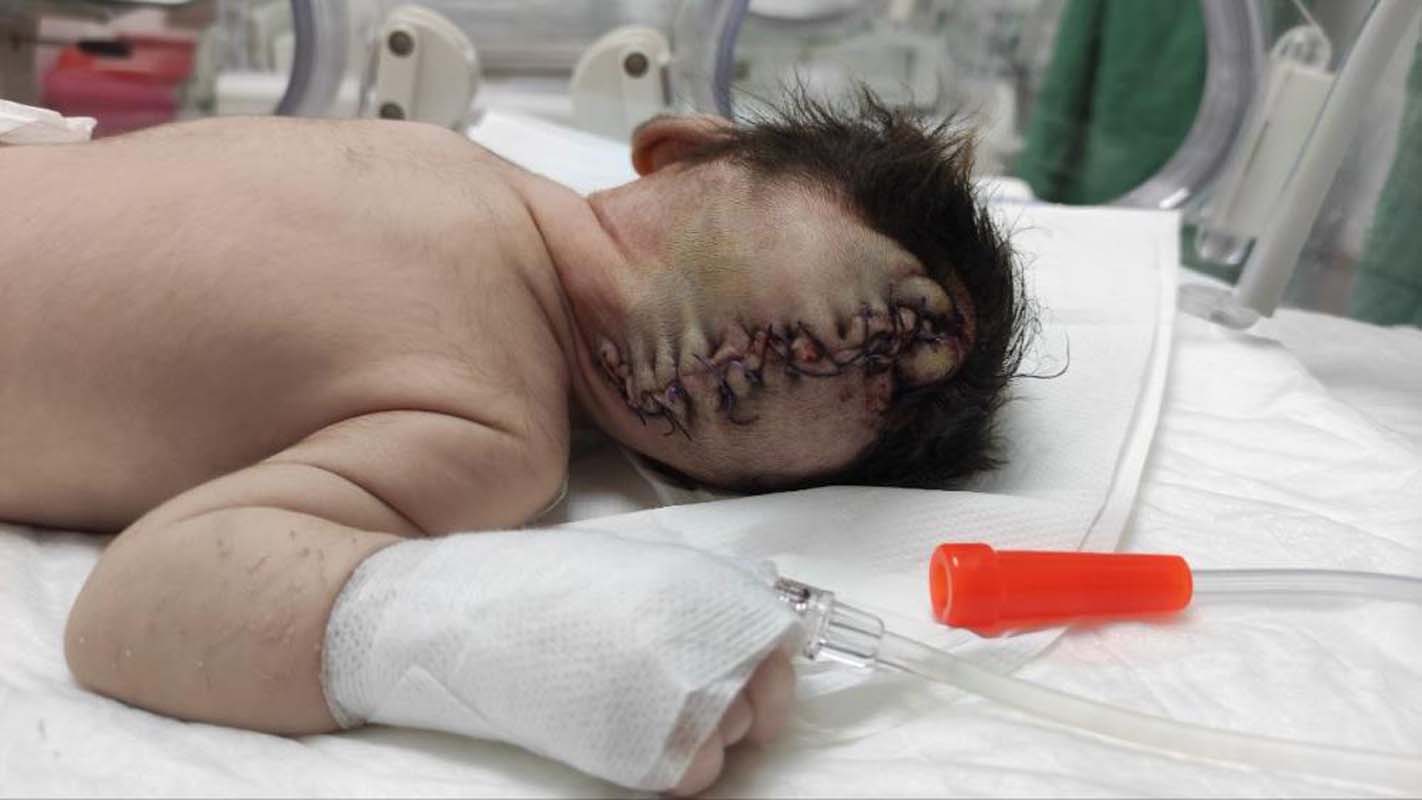 Kahramanmaraş'taki bebeği gören inanamadı! Beynin yarısı kafatasının dışındaydı! Daha 11 günlükken...