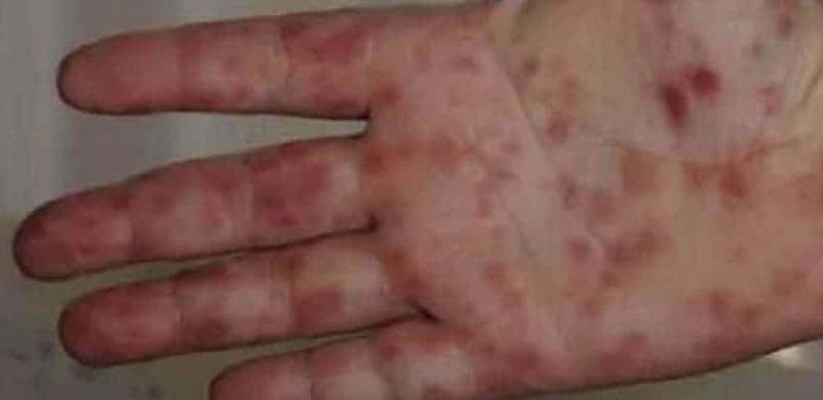 Bilim Kurulu Üyesi Mehmet Ceyhan korkutucu bilgiyi böyle verdi! O hastalık için herkesi uyardı! Çok sayıda ölüm ve sakatlık olur