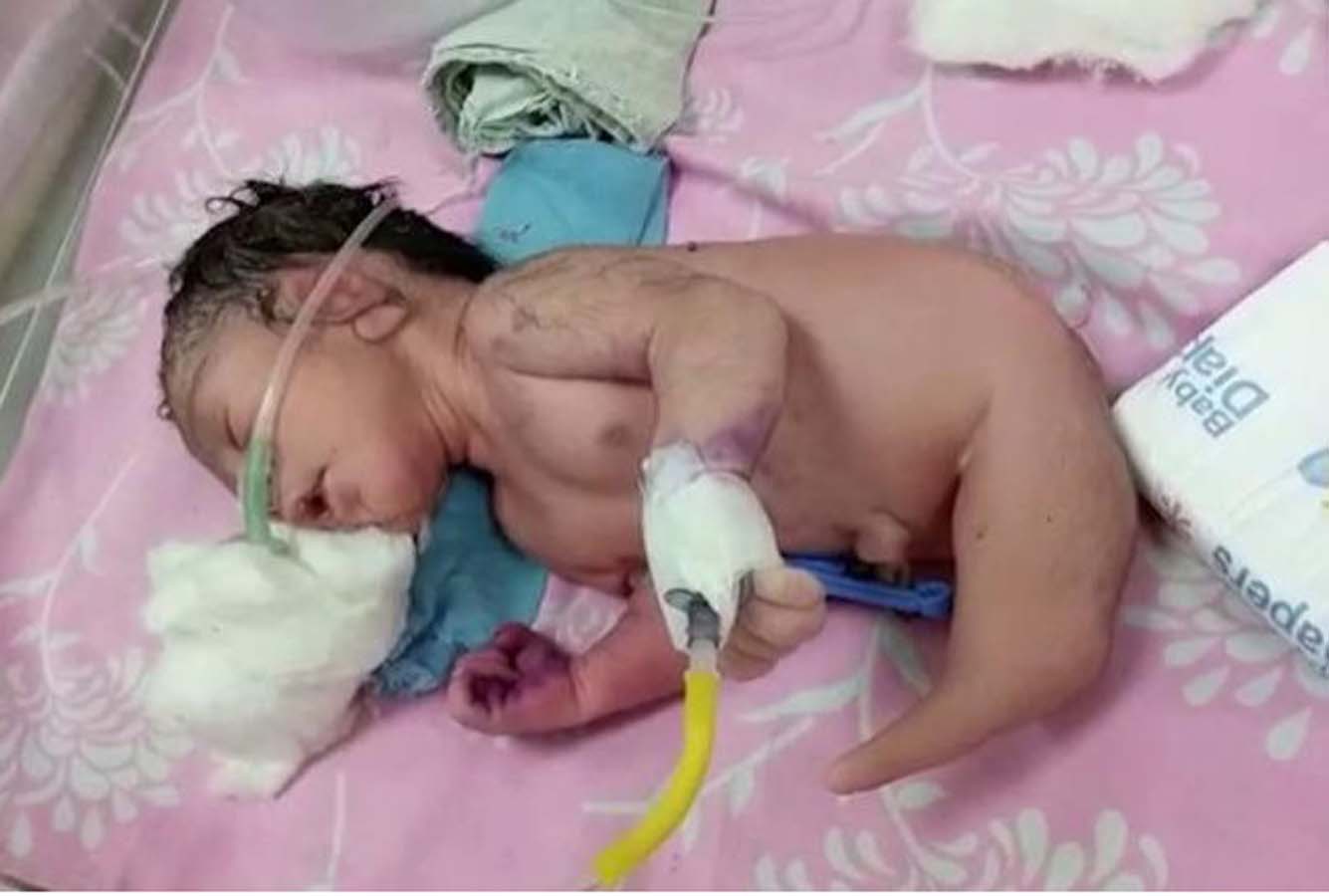 Doktorlar bebeğin belden aşağısını görünce şok oldu! Yeni doğan bebeğin bacakları yerine olan şey ağızları açık bıraktı!