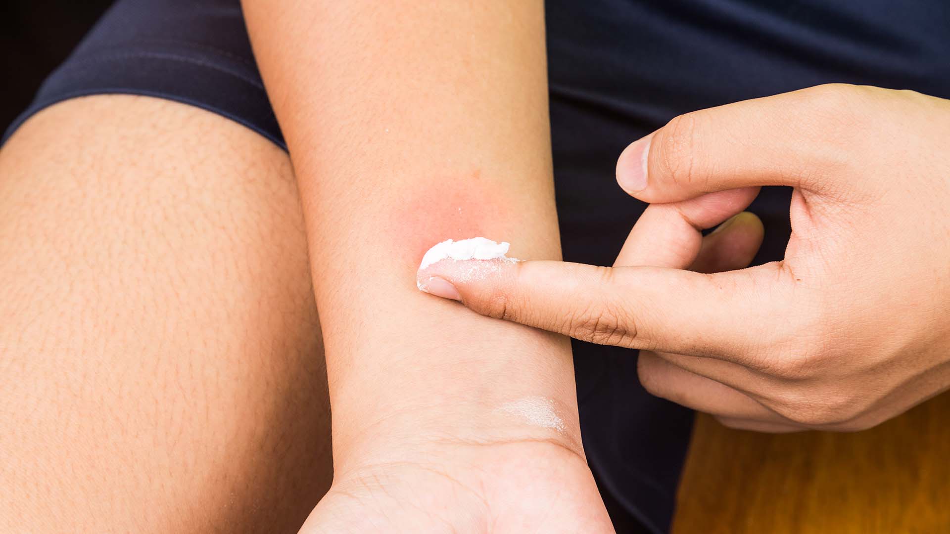 İstanbul'da sivrisinek alarmı! Belirtileri gösterenler anında hastaneye koşuyor! Uzmanlardan kritik uyarı geld!