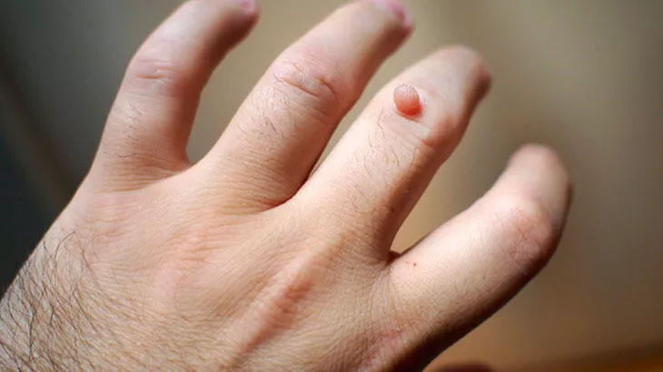 Rüyada et beni görmek, et beni çıktığını görmek ne demek? Rüyada et beni koparmak, vücuttan kir çıkarmak tabiri