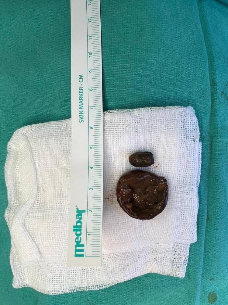 Zonguldak'ta bir garip vaka! 50 yıl boyunca burnunda mermiye yaşadı!