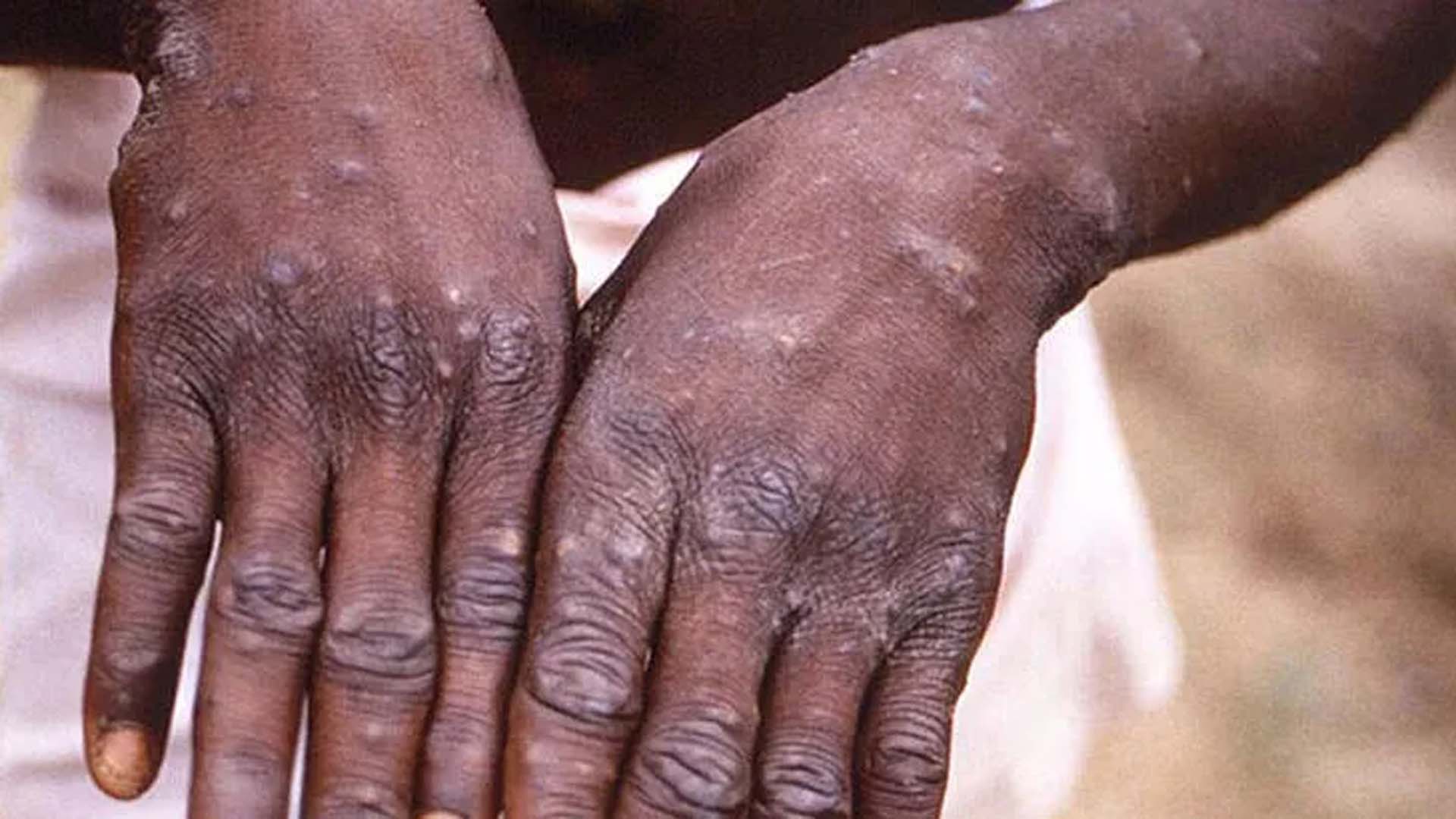 DSÖ son maymun çiçeği vakalarını hakkında bilgilendirdi! 70 binden fazla vaka var