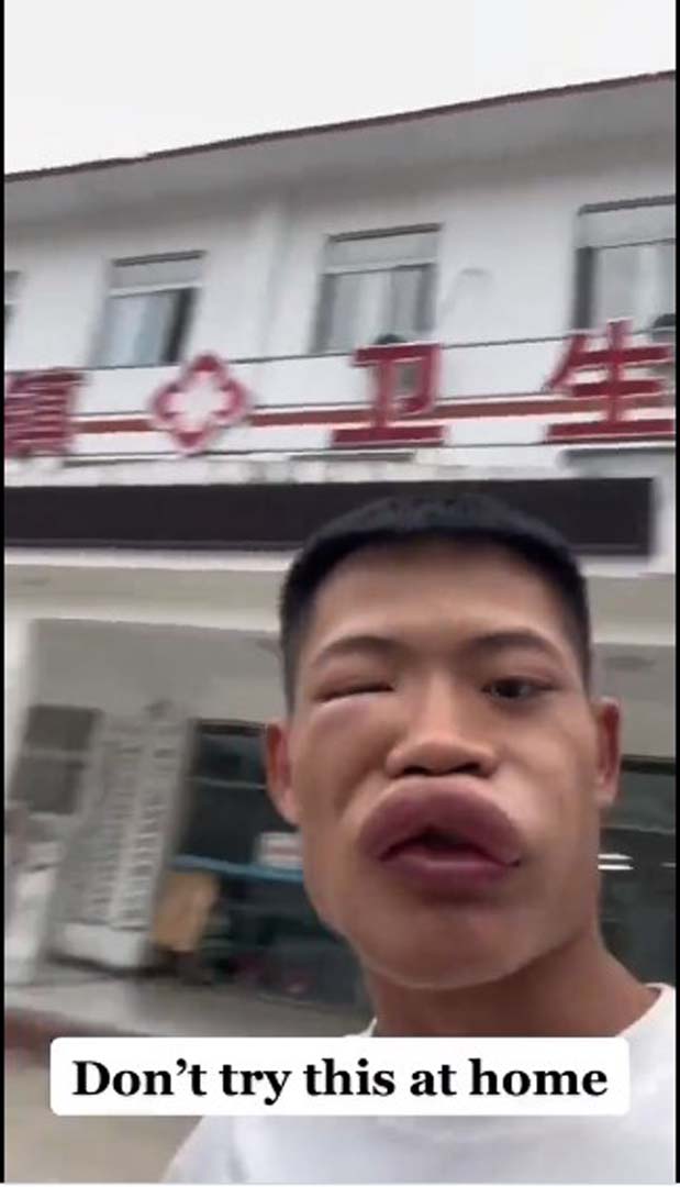 Genç influencer yemeye çalıştığı hayvandan derin darbe aldı! Akıllanmadı, tekrarı olacağını söyledi!