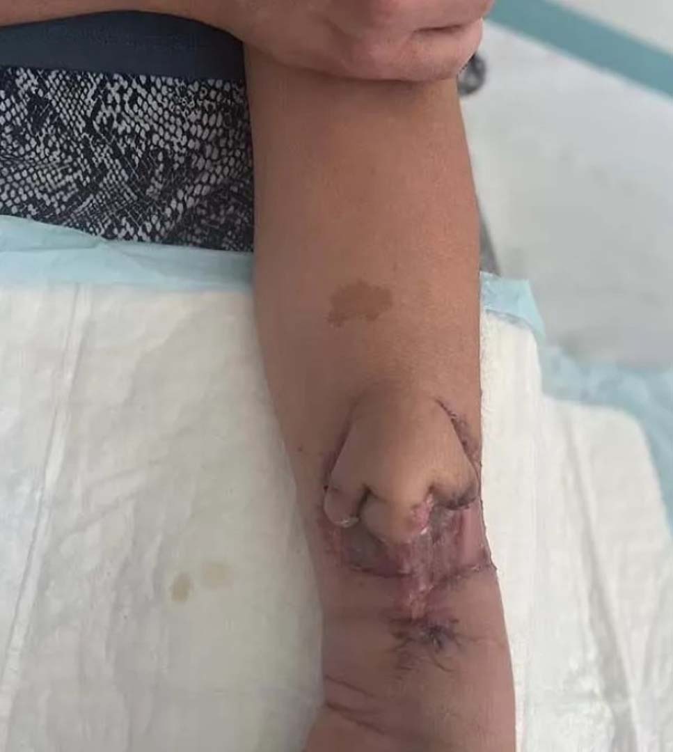 Kanser yüzünden burnunu kaybetmişti! Çığır açan teknoloji sayesinde burun öyle bir yerde üretildi ki...