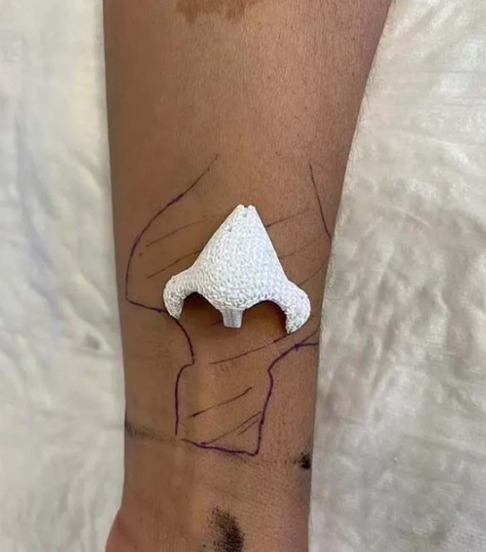 Kanser yüzünden burnunu kaybetmişti! Çığır açan teknoloji sayesinde burun öyle bir yerde üretildi ki...