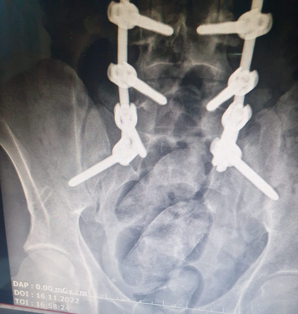 İranlı şüphelinin midesinden çıkanlar şoke etti!