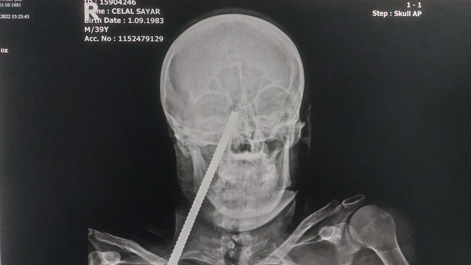 Giresun'da şoke eden olay! Yüzüne demir saplanan adam hastaneye kaldırıldı