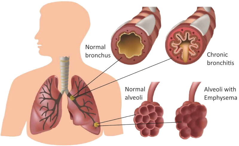 Bronşit Nedir, Çeşitleri Nelerdir? Bronşit Tedavisi Nasıl Olur?