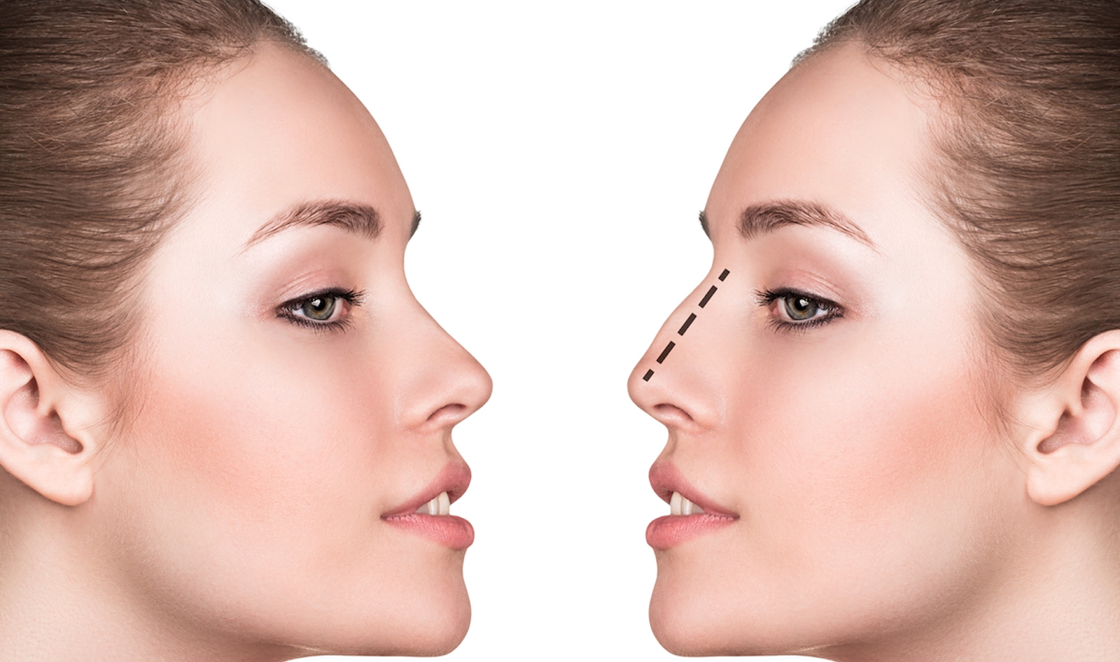 dogal-burun-estetiginde-basari-hangi-noktalara-baglidir.jpg