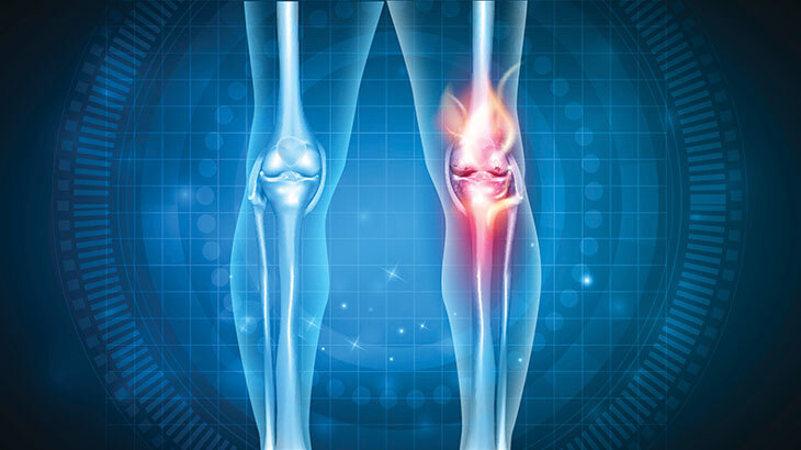 Osteoartrit Nedir? Belirtileri, Nedenleri ve Tedavi Yöntemleri Nelerdir?