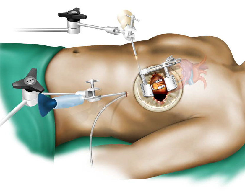 Koltuk Altı Kalp Ameliyatı Nedir? Avantajları Nelerdir, Kimlere Uygulanır? Prof. Dr. Yavuz Beşoğul Yanıtladı!