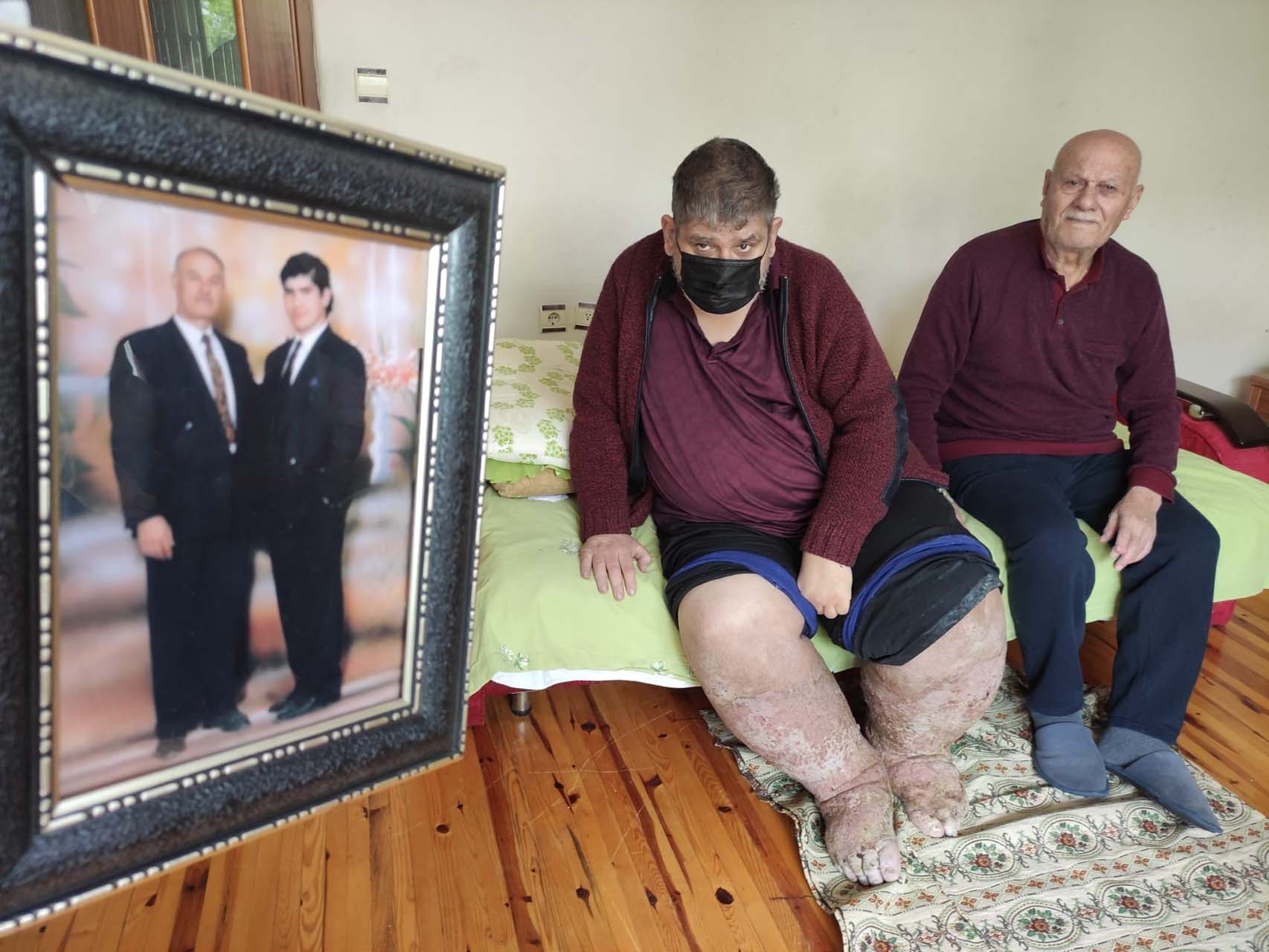 Sivrisinek ısırığı can aldı! Fil ayağı hastalığın yakalanan adam hayatını kaybetti.