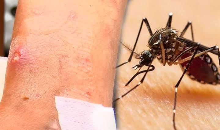 Asya kaplanı sineği tehlikesi giderek artmaya başladı, Asya kaplanı sivrisinek ısırığına doğal önlem