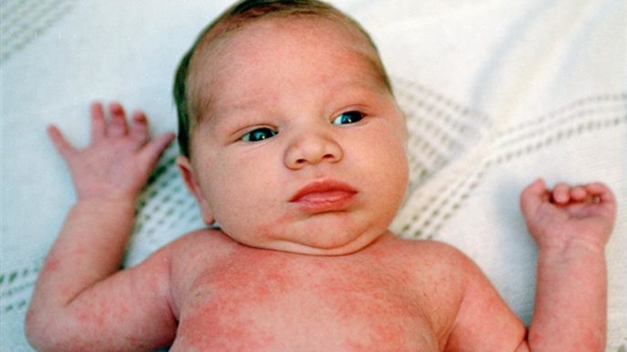 En çok çocukları etkiliyor! yaz hastalıklarına dikkat!