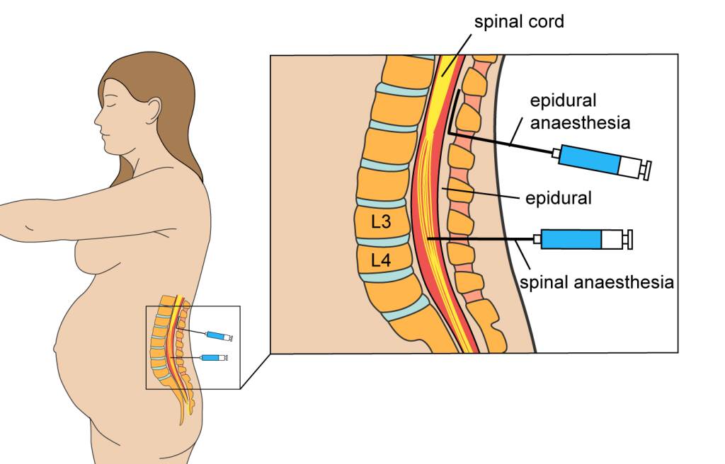 epidural-ne-demek2.jpg