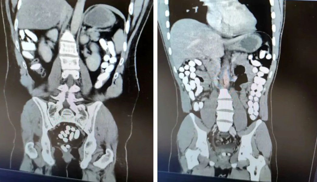 Midesinden 2 kilo uyuşturucu çıktı! İranlı kuryeci tutuklandı!