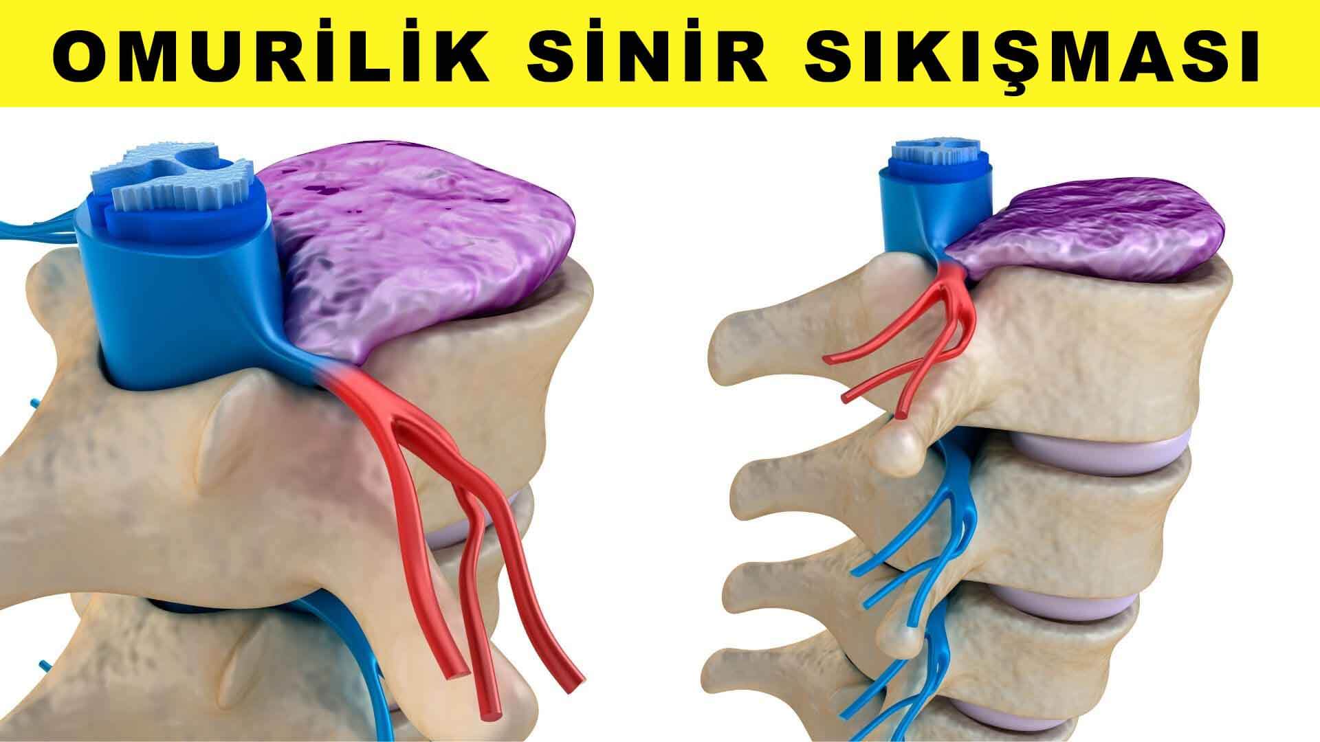 sinir-sikismasi.jpg