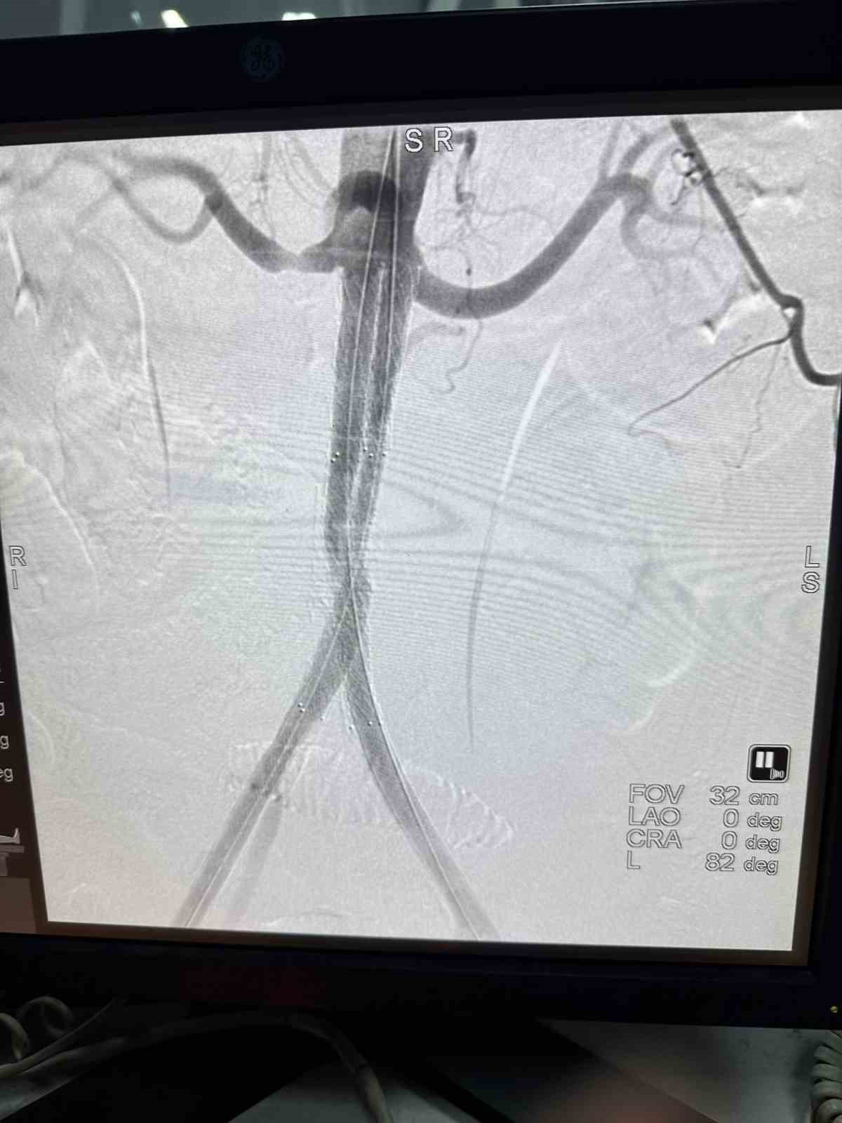Artık yerli yapay damarımızı kendimiz üretiyoruz! Damar nakli yapılan hasta hayata döndü!