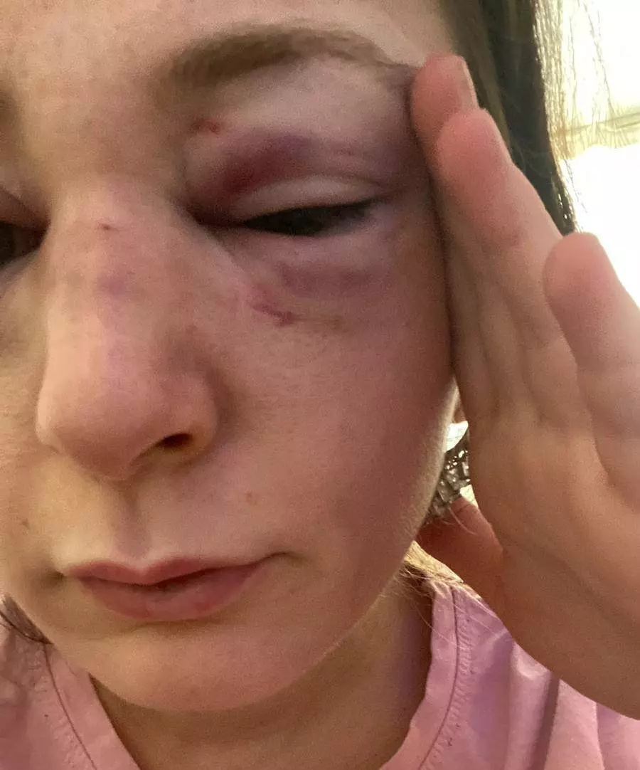 Eski sevgilisi 9 defa yüzüne kafa attı! Yüzü tanınmaz hale geldi!