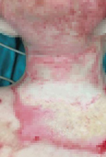 Youtube'de moda olmuştu! Bursa Şehir Hastanesi'nin yanık servisi çocuklarla doldu!