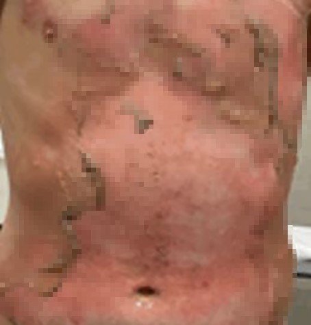 Youtube'de moda olmuştu! Bursa Şehir Hastanesi'nin yanık servisi çocuklarla doldu!