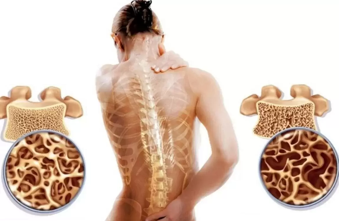 Fizik Tedavi ve Rehabilitasyon Uzmanı açıkladı: “Sessiz hırsız osteoporoz hastalığı kemikleri çalıyor”