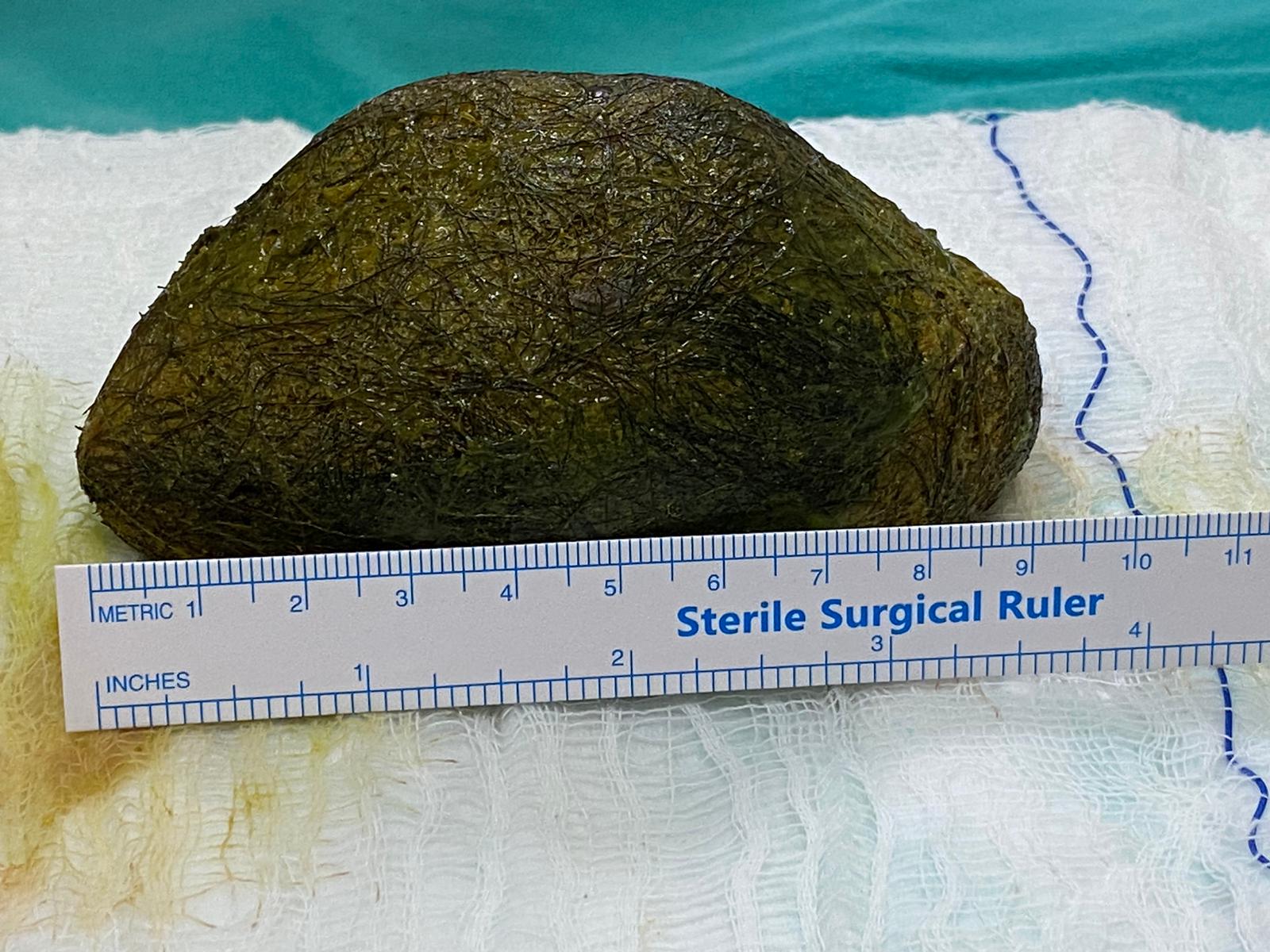 Osmaniye'de şaşkınlık yaratan olay! Karın ağrısı ile hastaneye giden hastanın mide ve bağırsağından bakın ne çıktı!