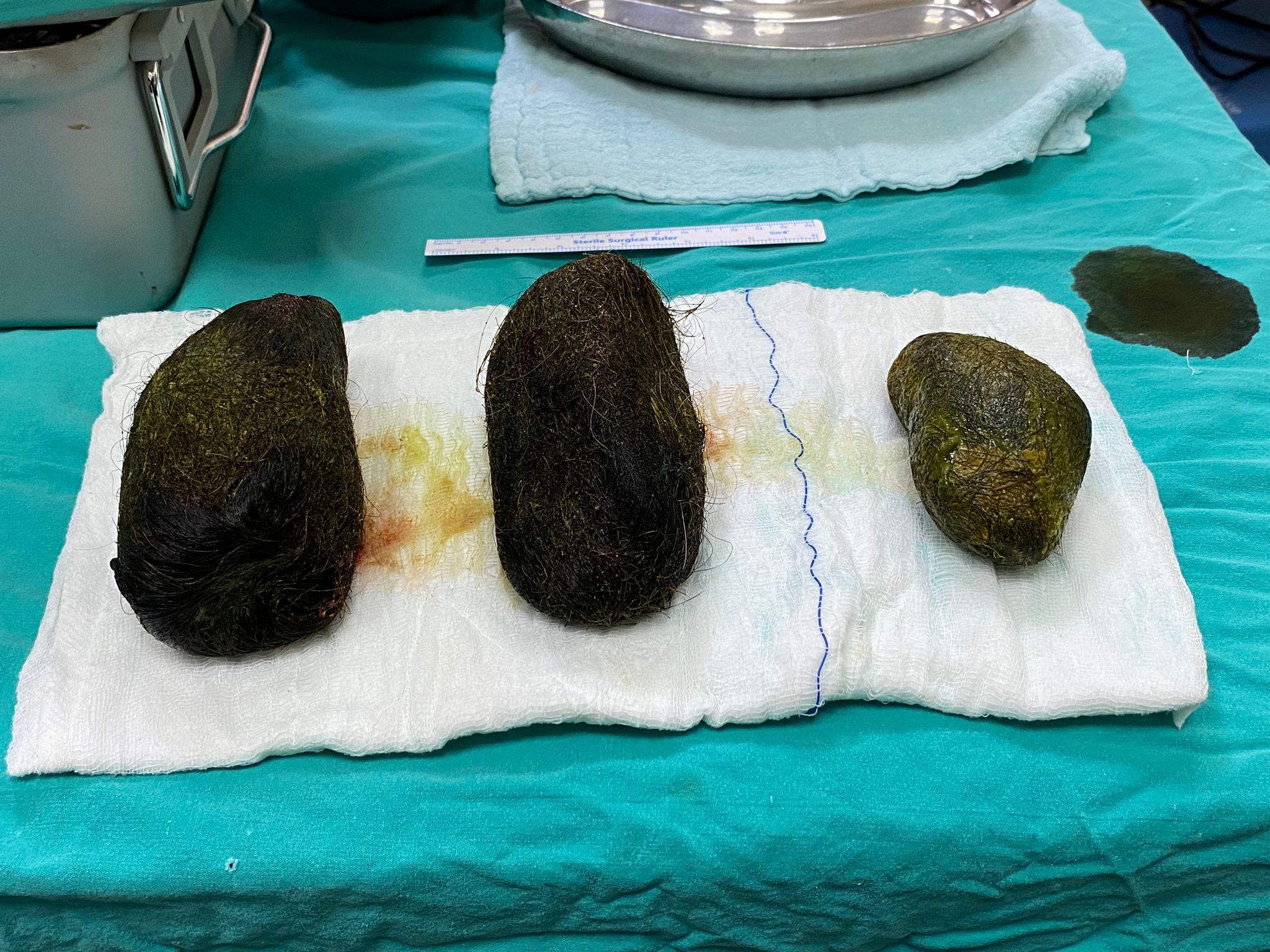 Osmaniye'de şaşkınlık yaratan olay! Karın ağrısı ile hastaneye giden hastanın mide ve bağırsağından bakın ne çıktı!