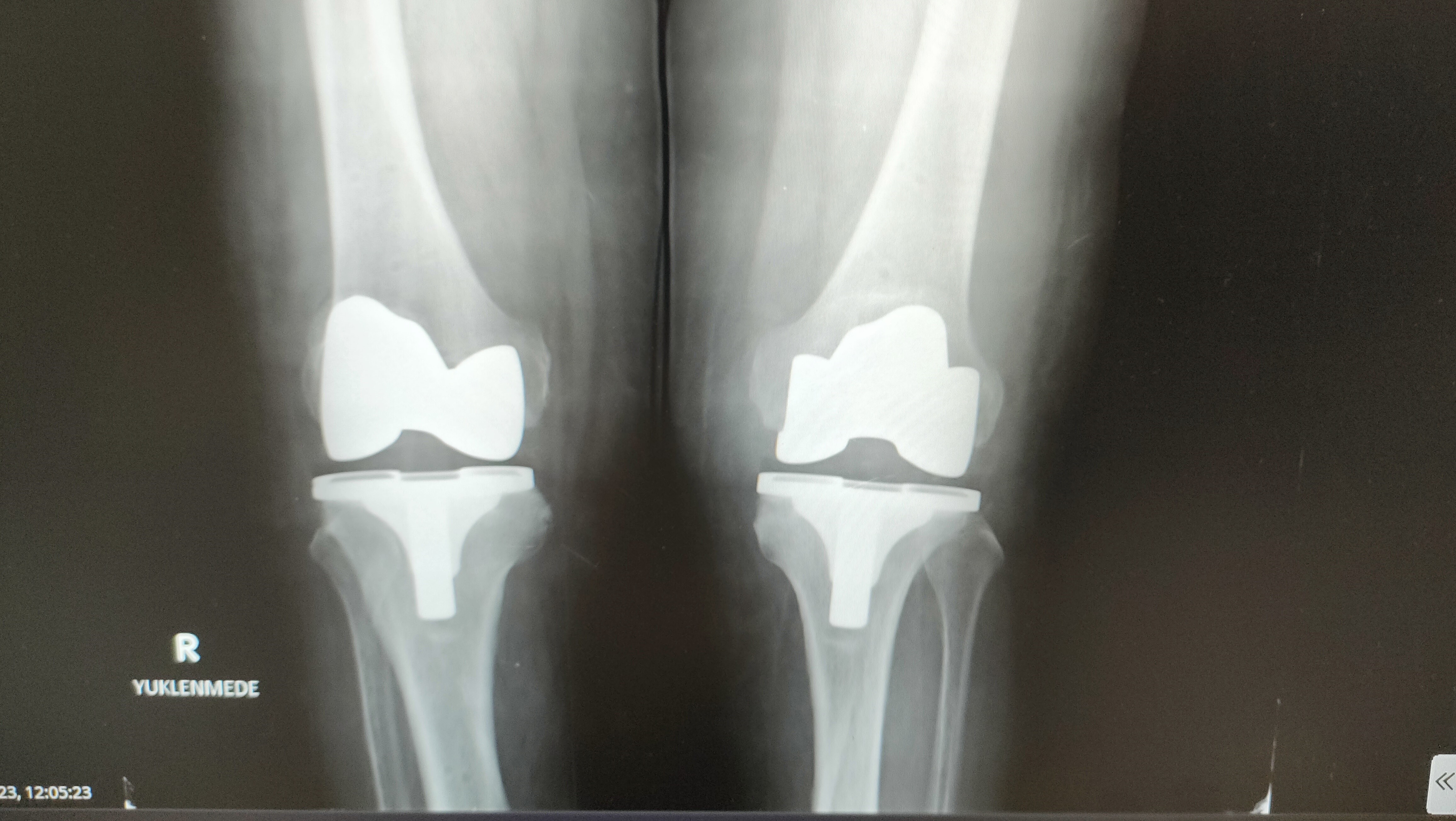 Uzmanların tavsiye ettiği bu robotik protezler, diz ağrısı çekenlerin hayatını kolaylaştıracak!