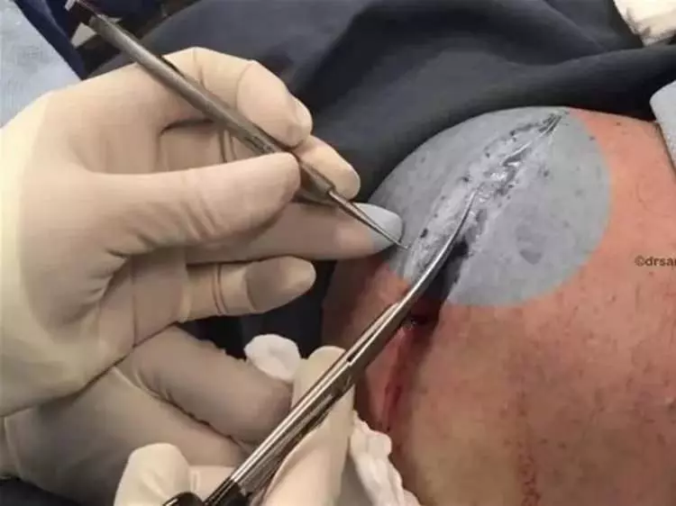 Ünlü doktor sosyal medyadan paylaştı! Boynundaki şişliğin içinden çıkan görenleri hayrete düşürdü!