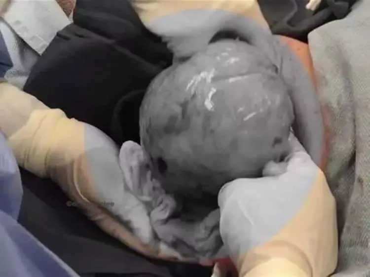 Ünlü doktor sosyal medyadan paylaştı! Boynundaki şişliğin içinden çıkan görenleri hayrete düşürdü!