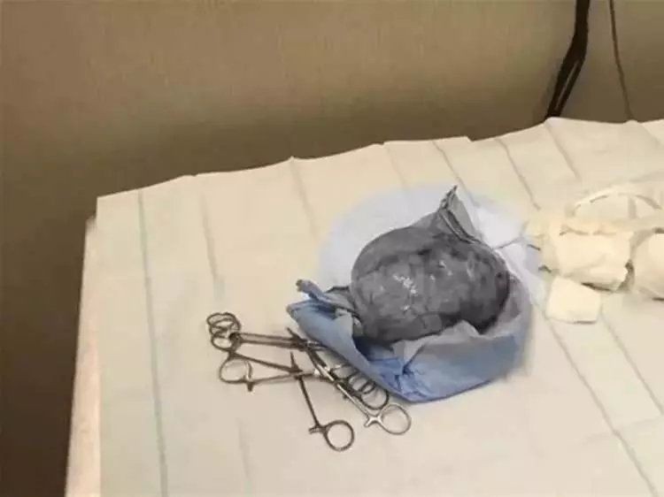 Ünlü doktor sosyal medyadan paylaştı! Boynundaki şişliğin içinden çıkan görenleri hayrete düşürdü!