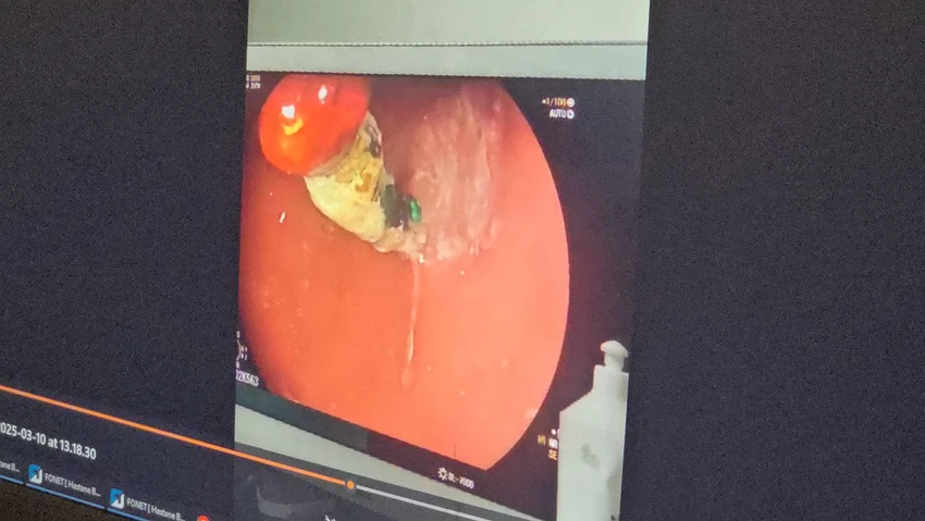 Uzmanlar uyardı: 4 yaşındaki çocuğun bağırsaklarından çıkanlar doktorları şoke etti!