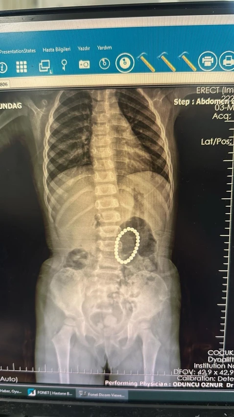 Uzmanlar uyardı: 4 yaşındaki çocuğun bağırsaklarından çıkanlar doktorları şoke etti!