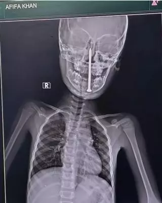 Beynine 8 santimetrelik çivi saplandı: 7 yaşındaki bir kız çocuğunun mücize kurtuluşu!