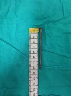 Beynine 8 santimetrelik çivi saplandı: 7 yaşındaki bir kız çocuğunun mücize kurtuluşu!