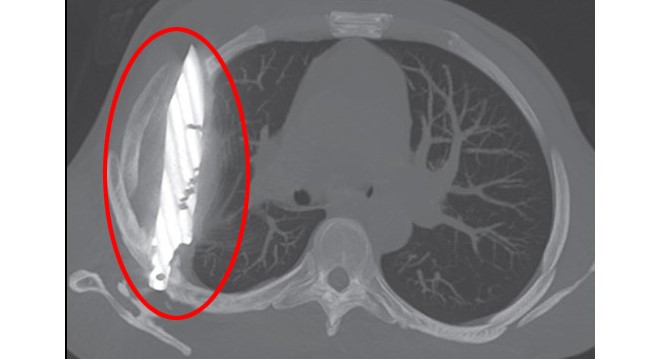 Göğüs ağrısıyla hastaneye gitti, gözlerine inanamadı: Göğsünde 8 yıldır av bıçağıyla yaşadığı ortaya çıktı!
