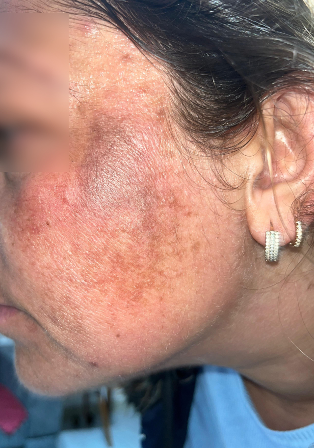 Yaptırdığı "Prenses cilt bakımı" yüzünü öyle bir hale soktu ki: Oğlum bana "öcü" diyor!