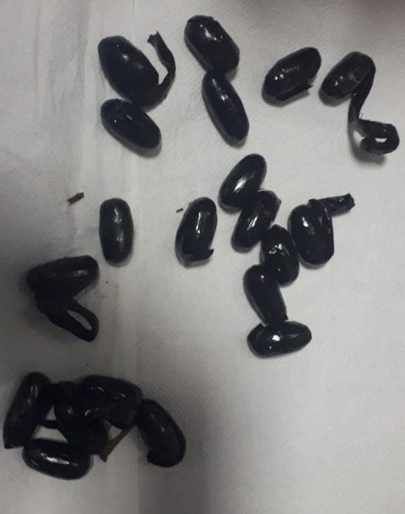 Midesinden 198 gram 30 kapsül uyuşturucu çıktı!