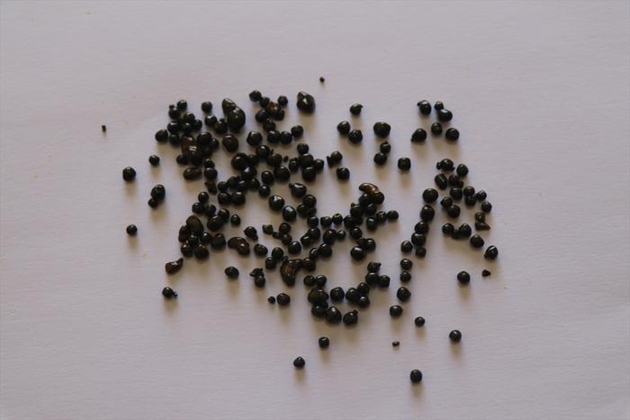 Safra kesesinden 200 tane taş çıktı!