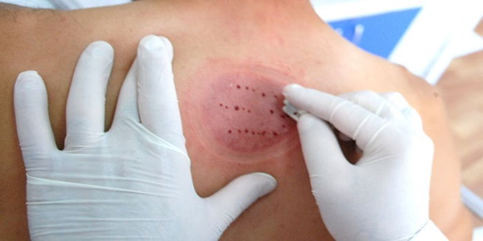 Hacamat nedir? Nasıl yapılır? Faydaları nelerdir? Zararları nelerdir?