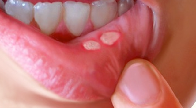 Aft nedir? Dilde aft neden çıkar? Aft nasıl geçer? Karbonatla aft tedavisi nasıl olur?